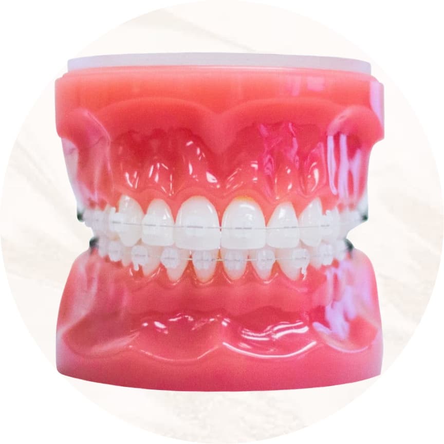 clear ceramic braces on model